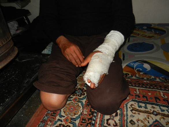 Alluhud’s hand in a cast, from continuously slamming his hand from nervous breakdowns